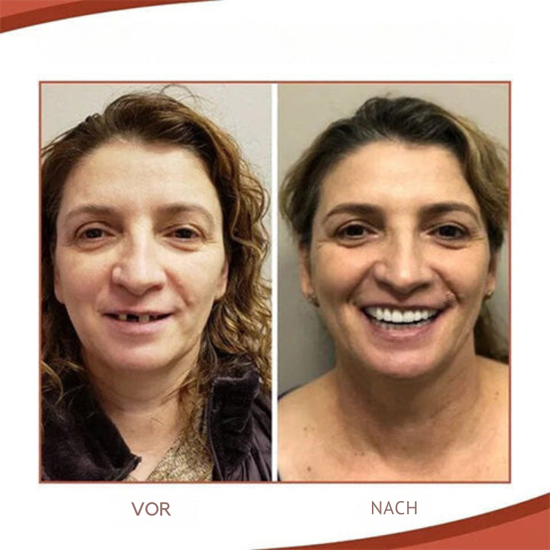 Cosmetic Tooth Cover Set Removable Upper and Lower for Photos and Events